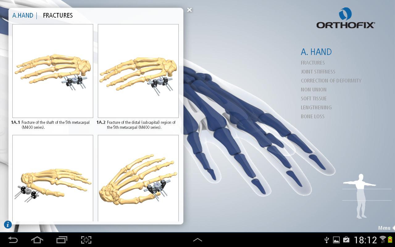 Orthofix ABS