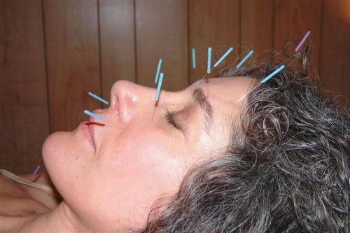 Accupuncture with Android