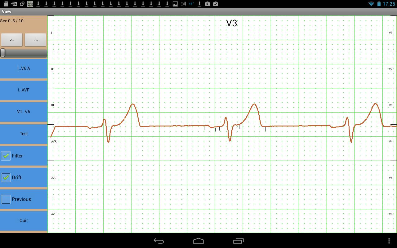 Mobile ecg recording