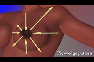 Altus Health  Breast Self Exam