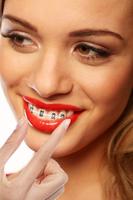 Fake Braces