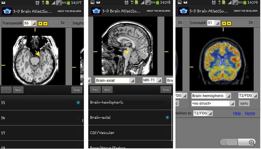 3-D brain Atlas